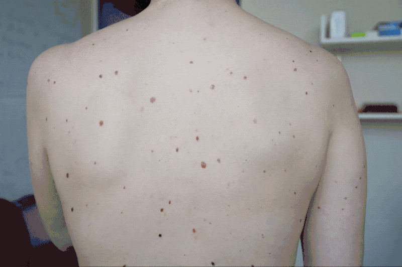 How a Team from MIT is Using an AI Tool to Detect Melanoma