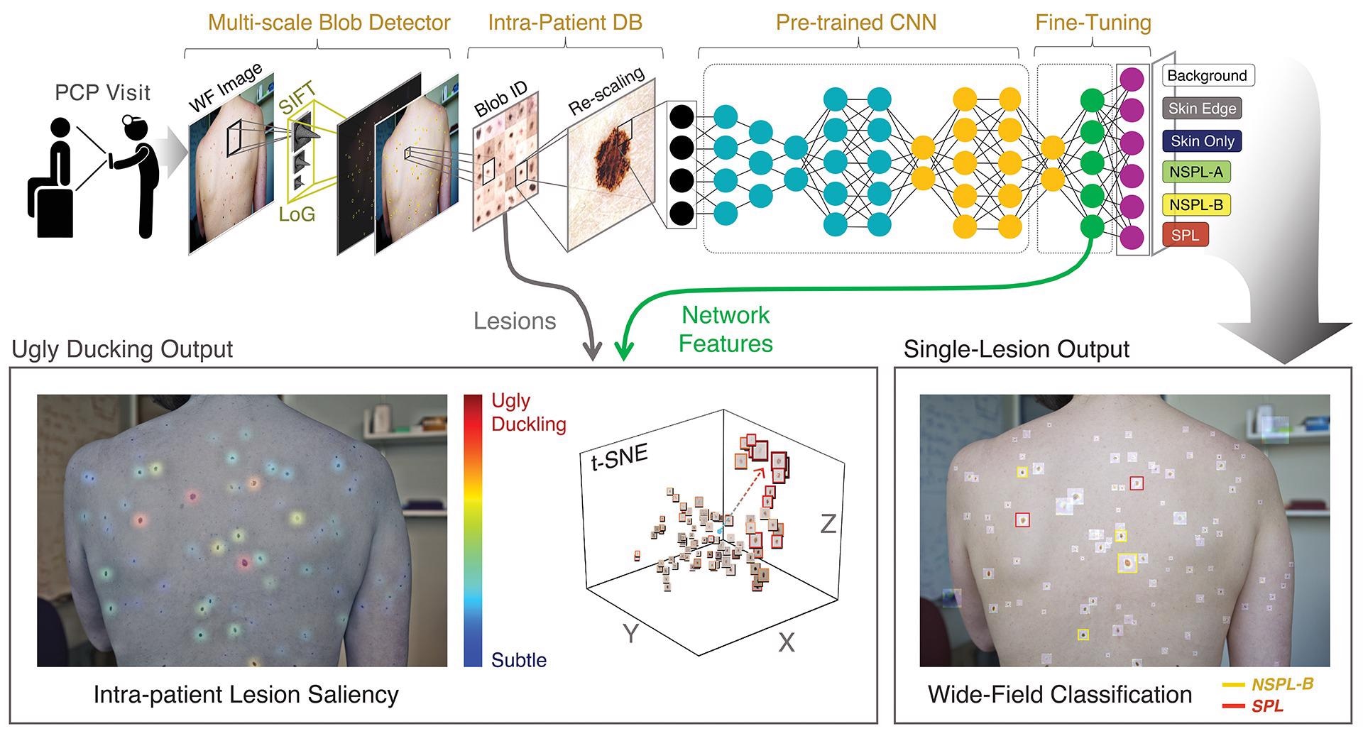 How a Team from MIT is Using an AI Tool to Detect Melanoma