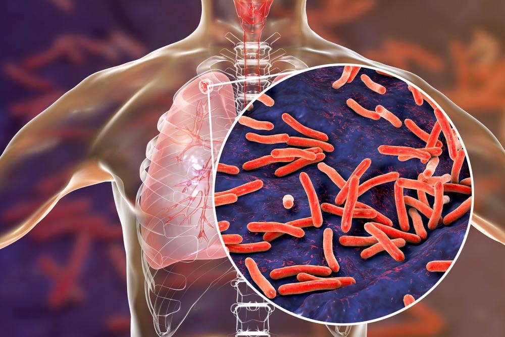 AI-Based Automated System for Detecting Pulmonary Tuberculosis