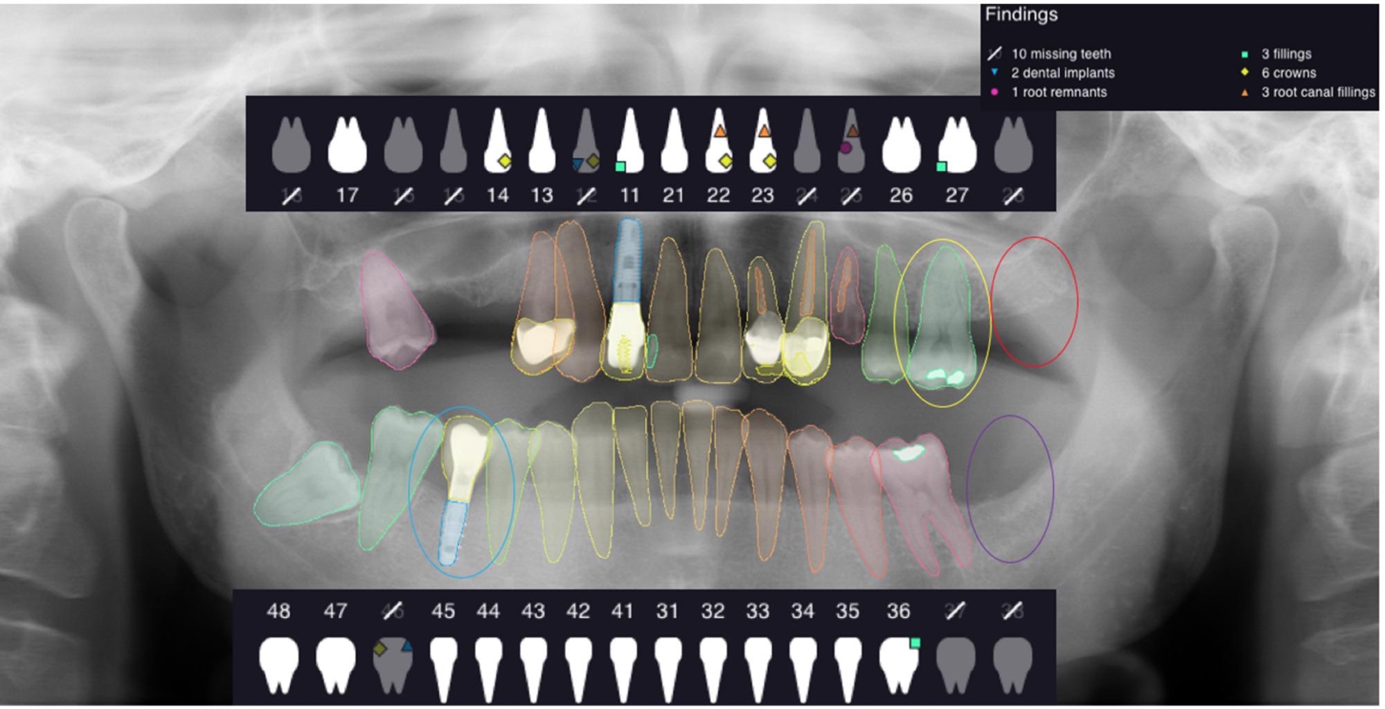 The figure shows an example of analyzed OPG and the outcomes given by the software.