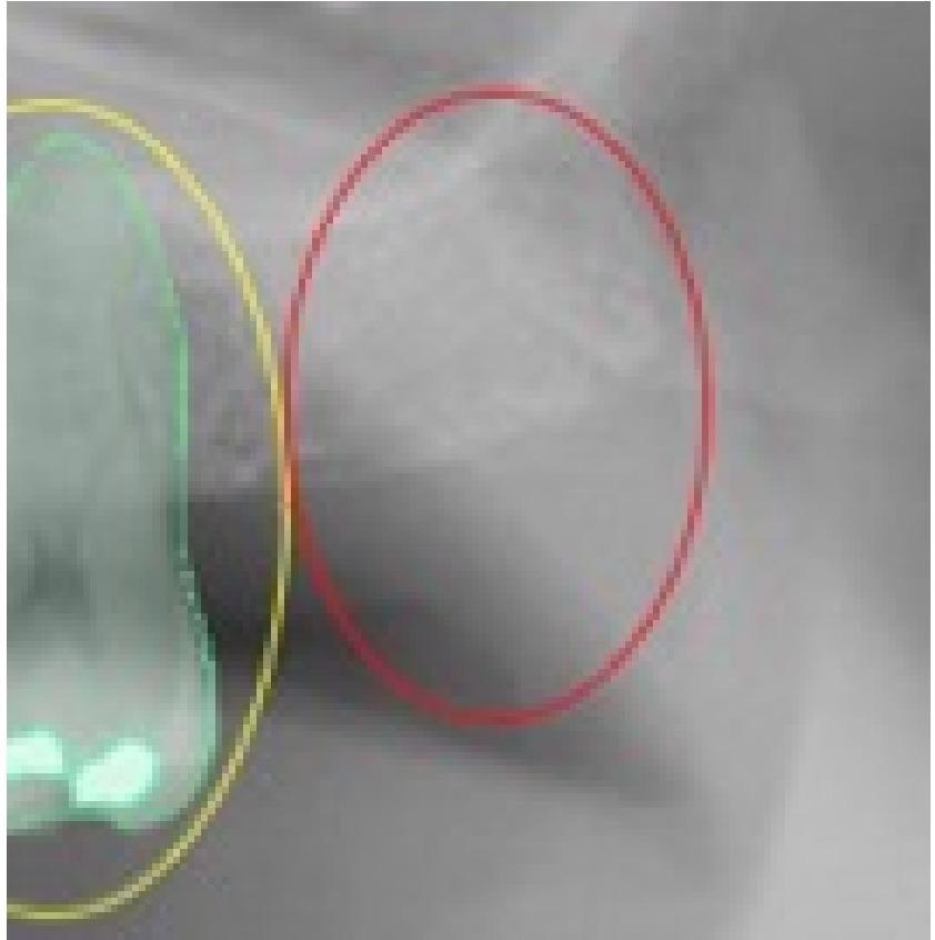 This selected view of Figure 1 shows the incorrect detection in the right position of the tooth 2.7. The assigned value was FP.