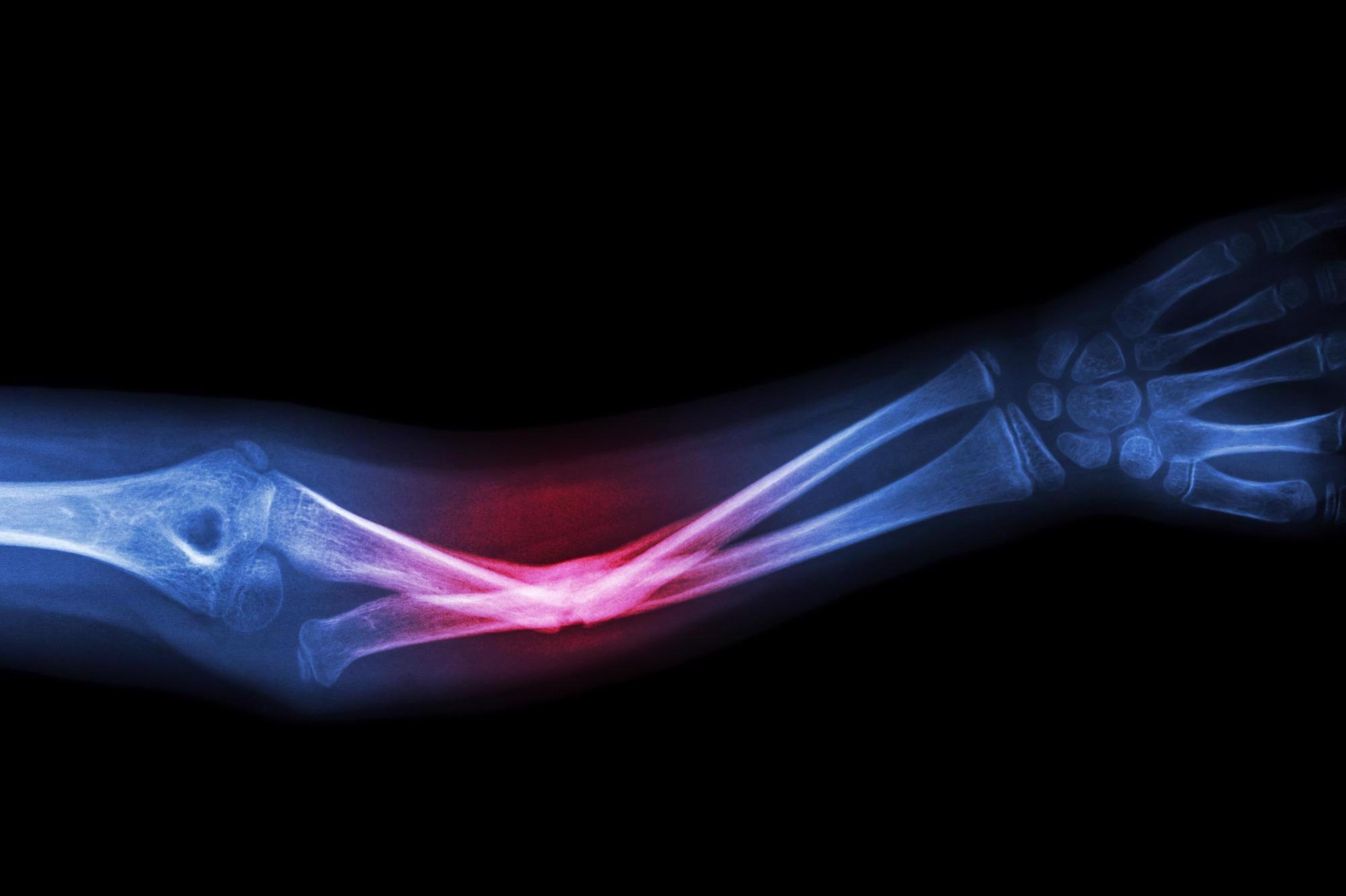 How AI can Help Assess X-Rays.