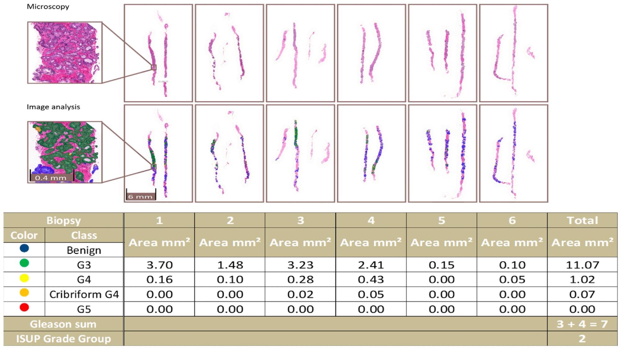 An example of a complete biopsy session slide set. Image analysis data are produced by pixel-level multi-class semantic segmentation at the level of the individual biopsy slide and compiled at the level of the complete slide set. In the example, the patient-level ISUP grade group is 2.