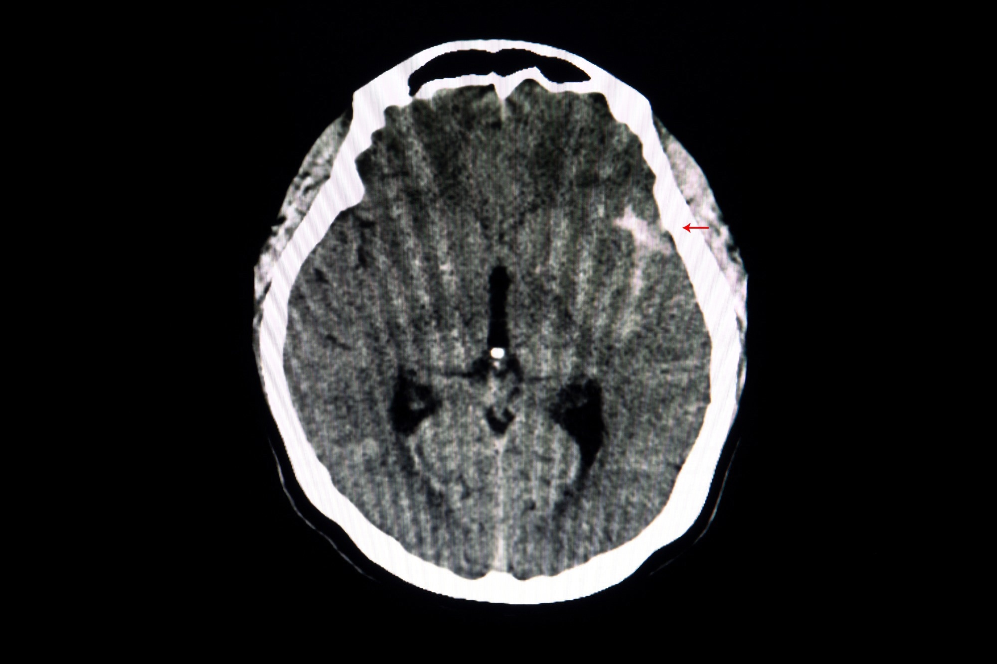 The Role of Deep Learning in Automating Aneurysm Diagnostics