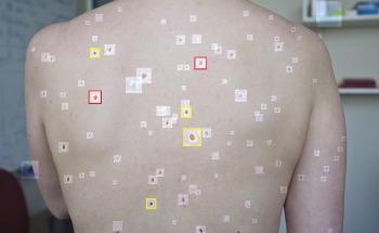 How a Team from MIT is Using an AI Tool to Detect Melanoma