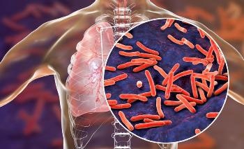 AI-Based Automated System for Detecting Pulmonary Tuberculosis