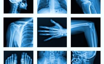 How AI can Help Assess X-Rays and Identify Positive Fractures