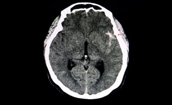 The Role of Deep Learning in Automating Aneurysm Diagnostics