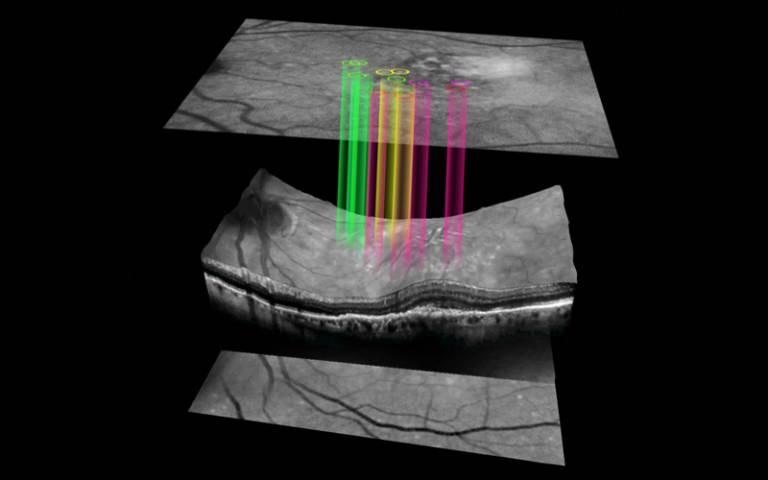 New AI-Based Eye Test may Predict Macular Disease Well Ahead