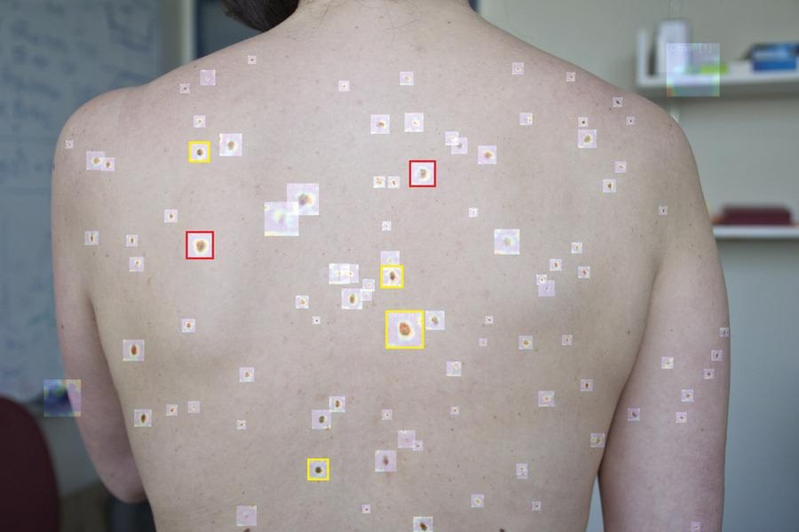 The Artificial Intelligence Tool that Can Detect Melanoma