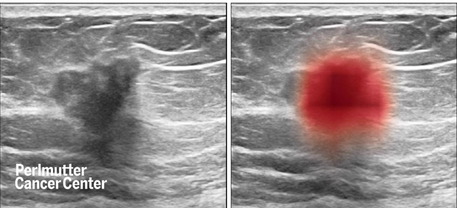 New AI Tool-Based Advancement in Breast Cancer Imaging.