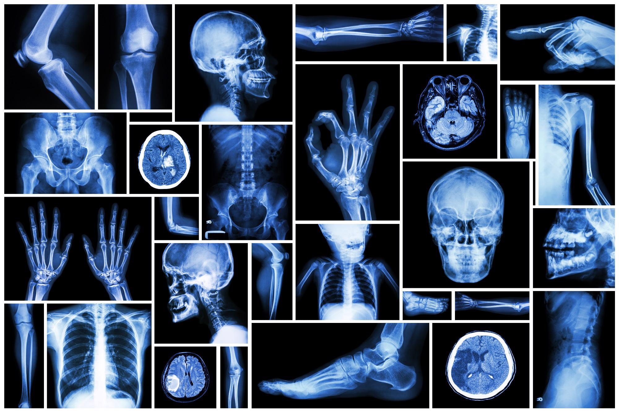 AI can Help Physicians Interpret X-Rays After Injury and Suspected Fracture