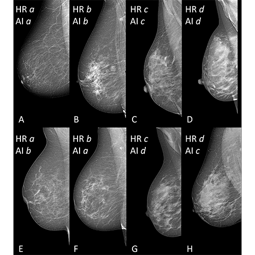 Artificial Intelligence Likely to Detect Breast Density, Says Study.