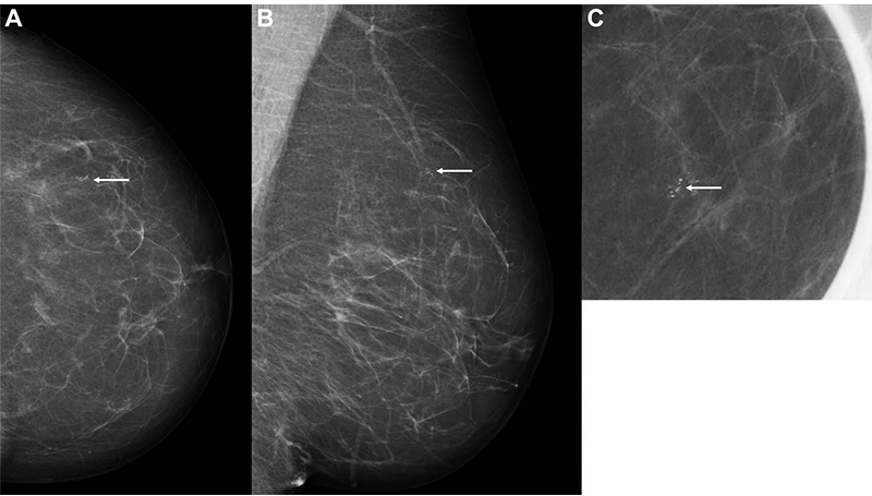 AI Used in Breast Cancer Diagnosis, Likely to Be a Promising Approach.
