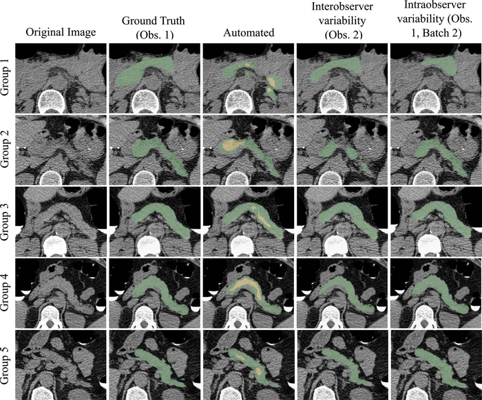 Study Shows How Abdominal CT Imaging Tool Helps to Treat Type 2 Diabetes.