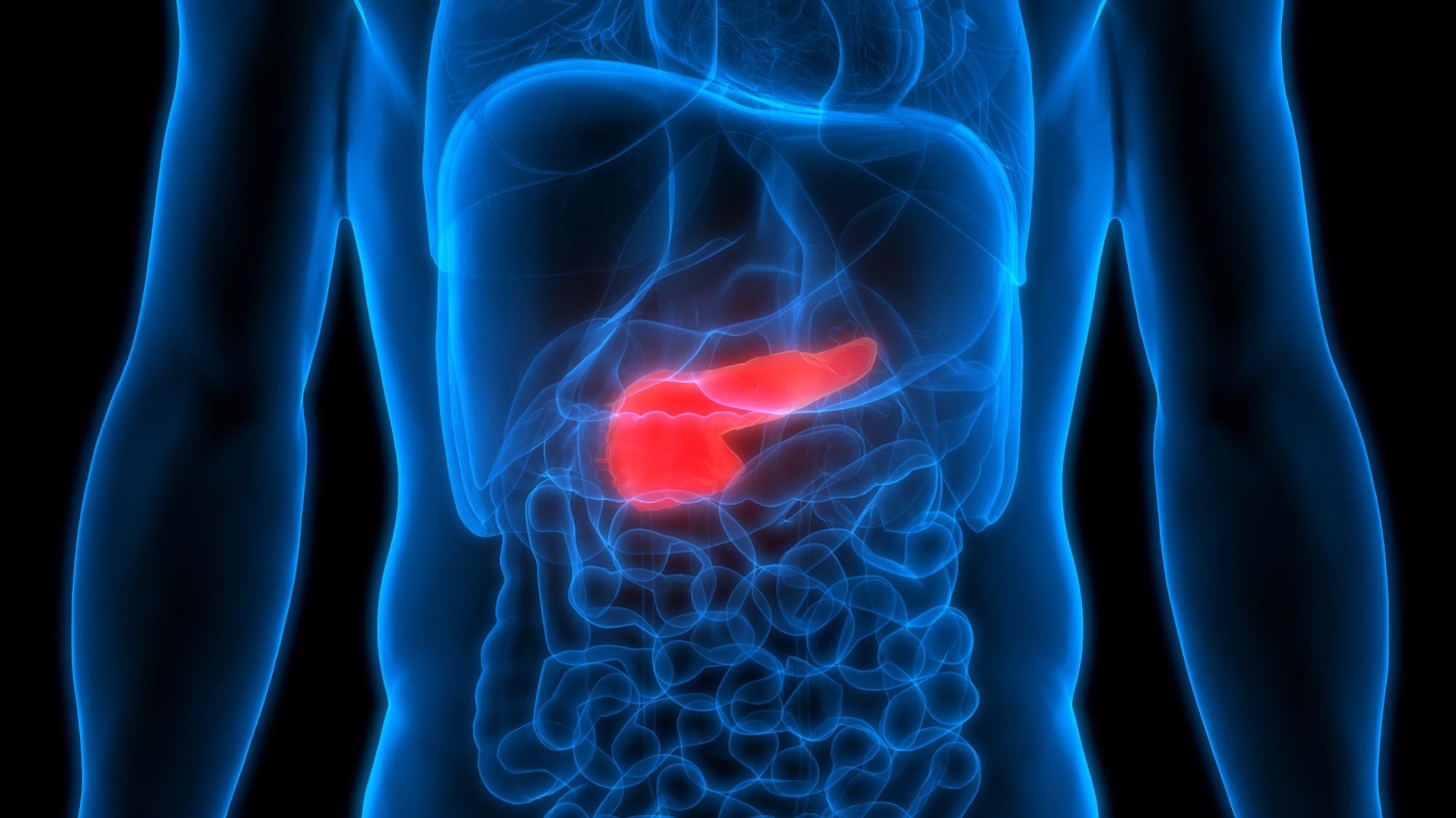 Pancreatic Cancer Risk Detected by AI-Based Model.