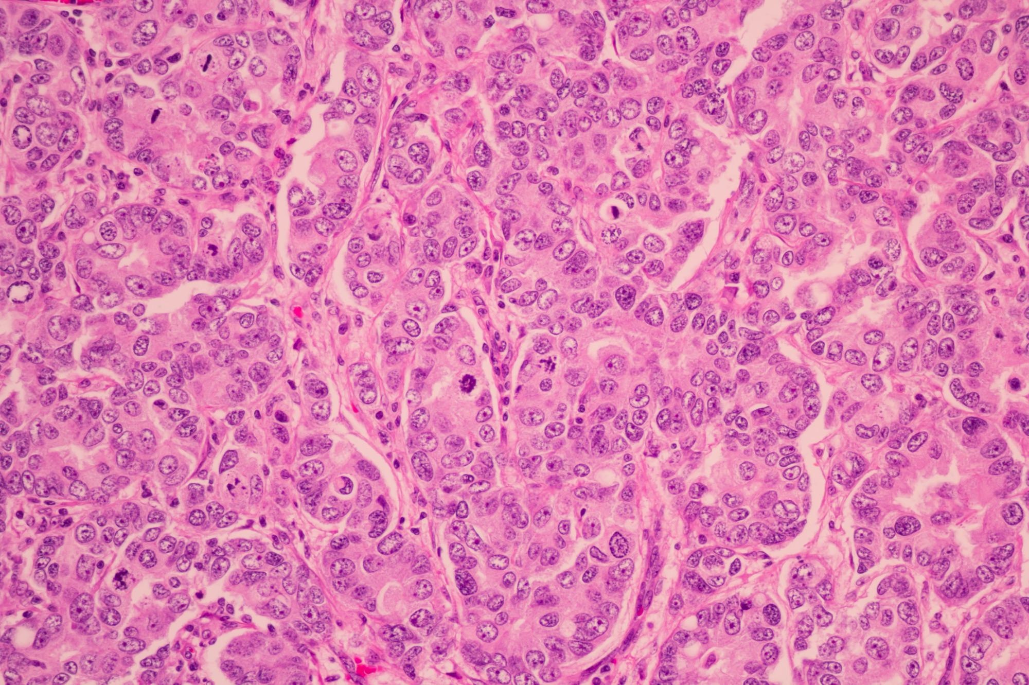 A New Method of Using AI to Predict Cancer from Patient Data Confidentially.