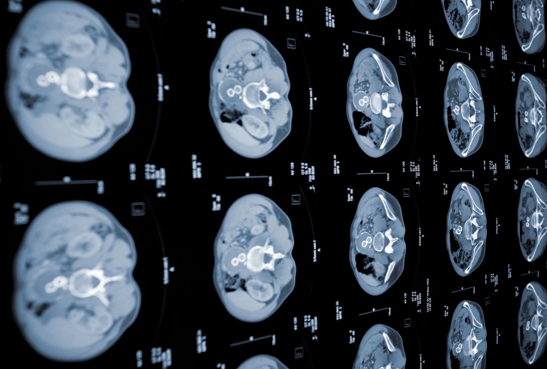 AI Helps to Detect Early Stage Pancreatic Cancer.