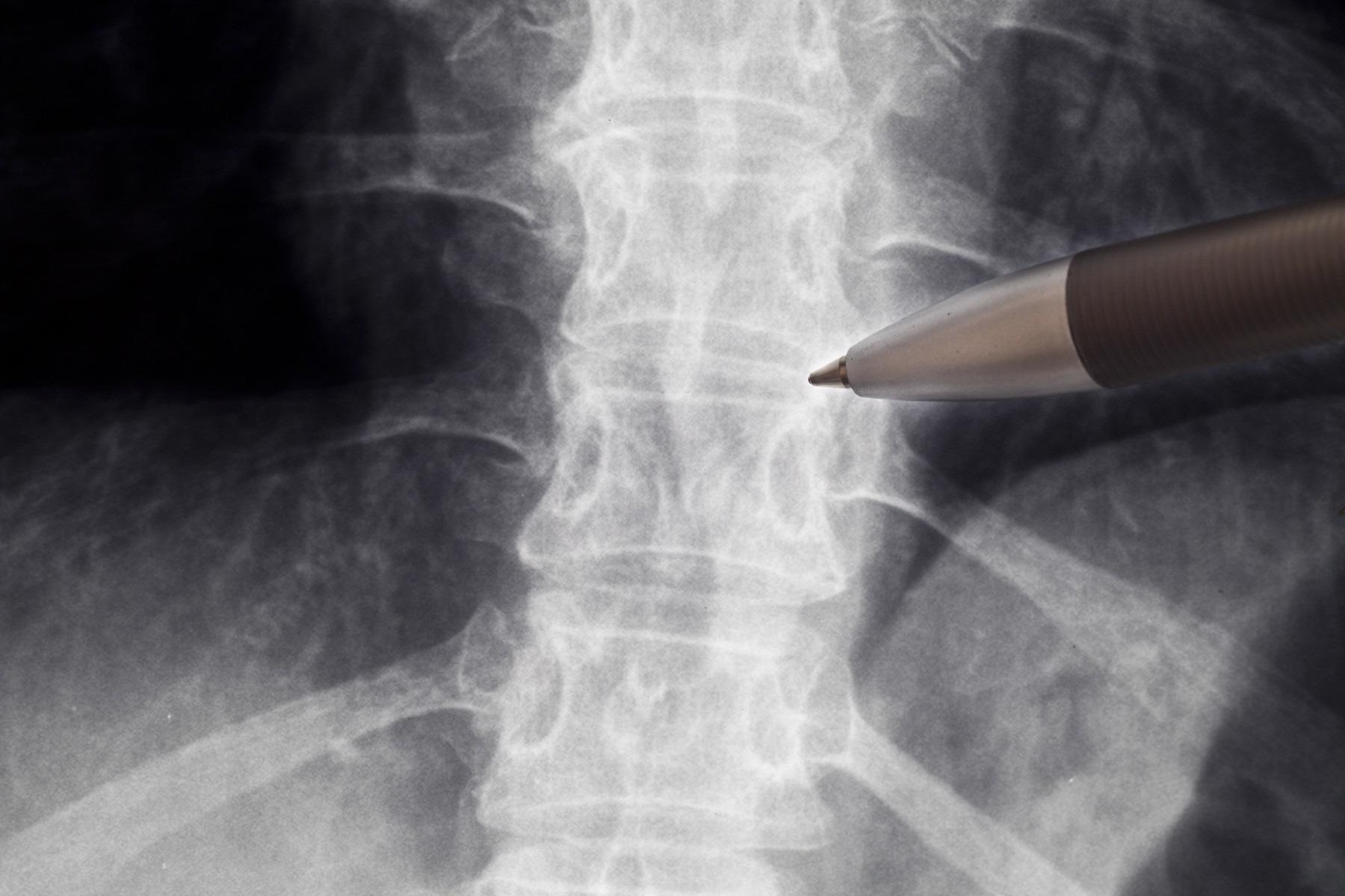 Artificial Intelligence May Help Researchers to Treat Bone Fractures with Better Understanding.