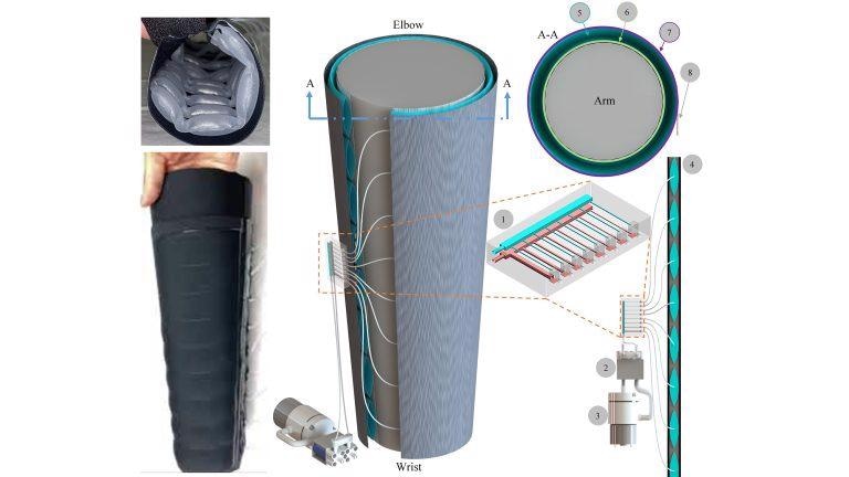 Novel Microfluidics-Enabled Soft Robotic Sleeve Enables Lymphedema Treatment.