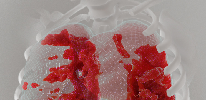 Researchers Develop New AI Tool to Detect Post-COVID Lung Problems.