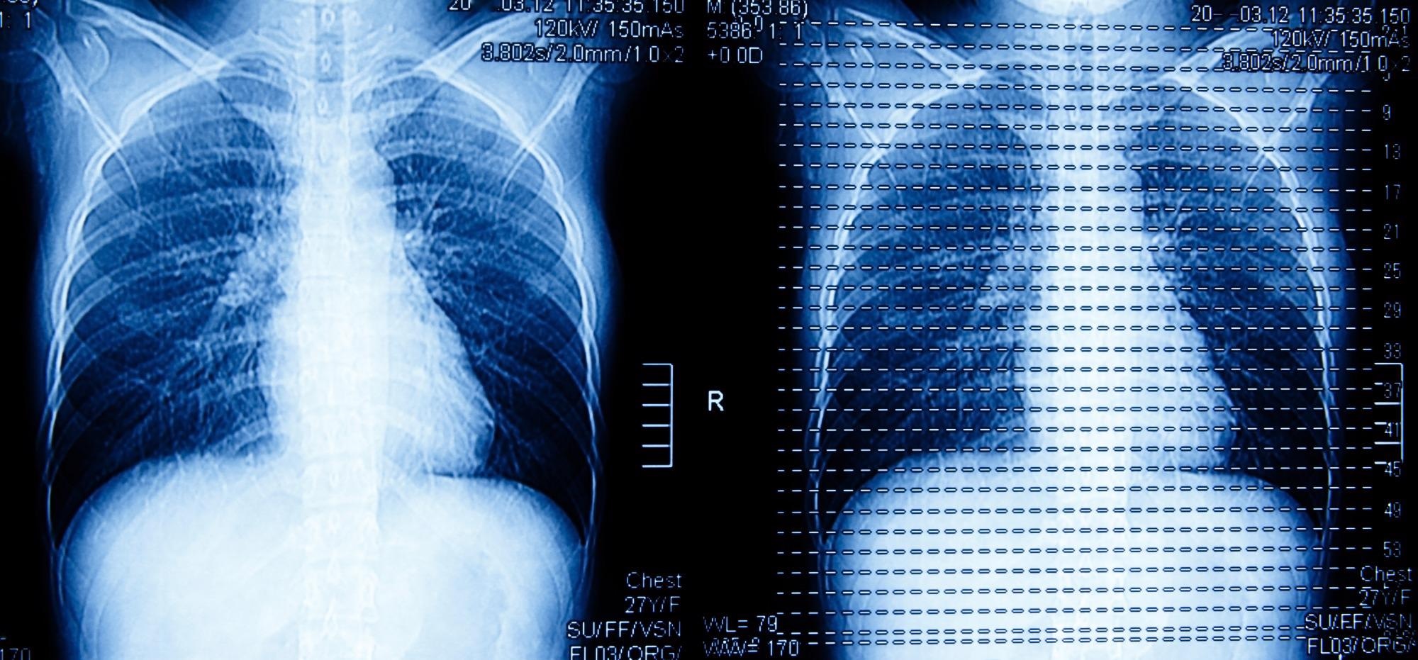 Scientists Shows AI Saving One Hour of Daily Chest CT Interpretation Time.