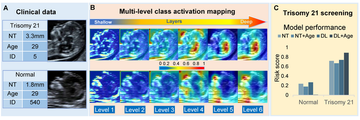 Researchers Utilize AI to Enable Non-Invasive and Precise Screening for Down Syndrome.