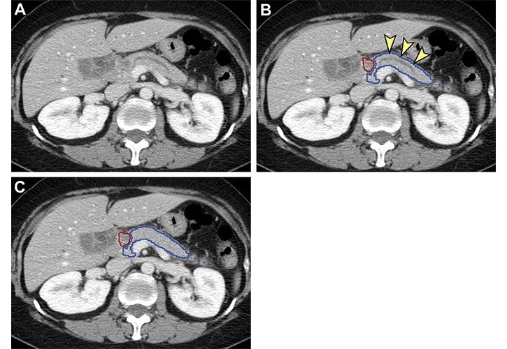 AI Tool Assists Early Diagnosis of Pancreatic Cancer