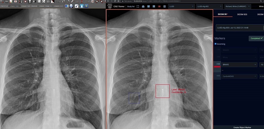 AI Detection of Implanted Electronic Devices for Patient Safety