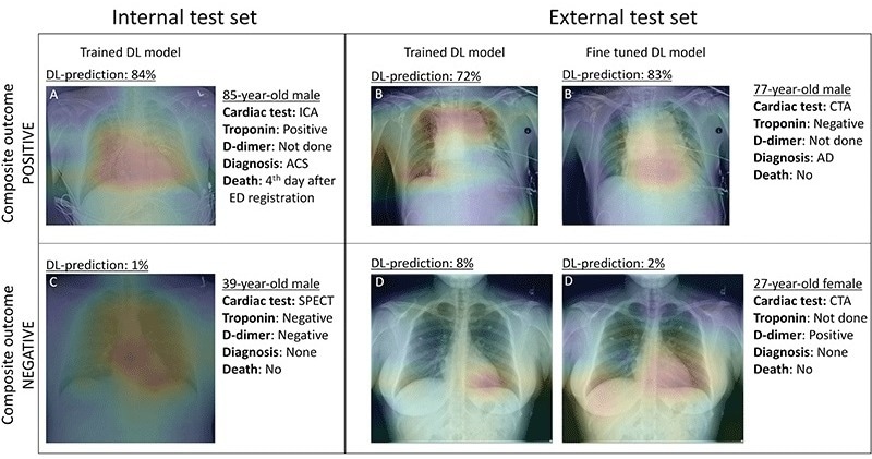 AI May Help Improve Care for Patients with Acute Chest Pain