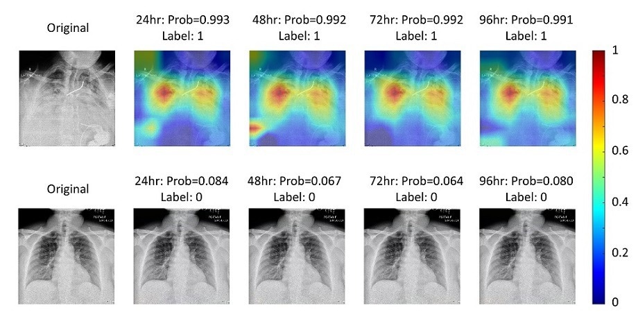New Deep-Learning Model Helps Determine Severity of COVID-19