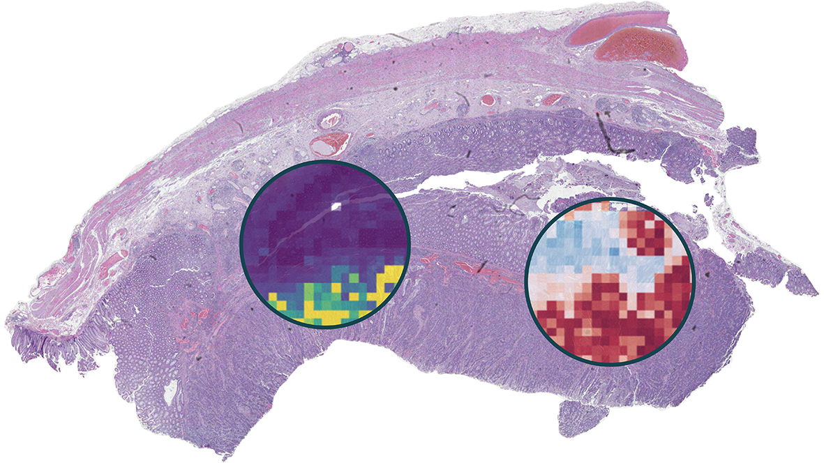 AI Predictions for Effective Precision Oncology