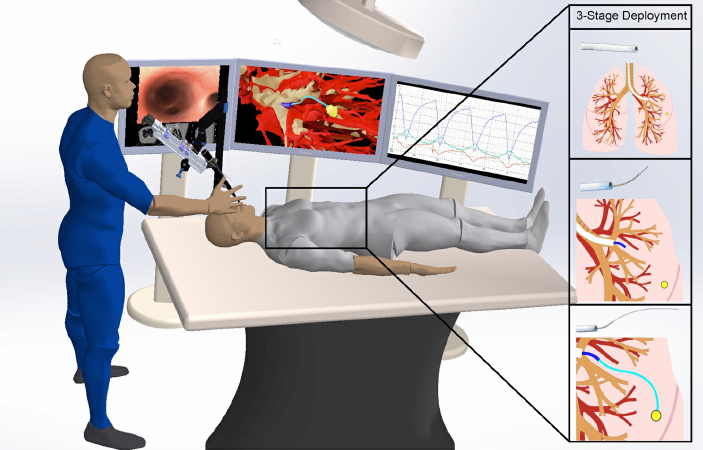 Robotic Needle Navigates Lung Tissue to Reach Tumors
