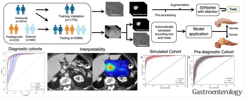 AI Algorithm Aids in the Early Detection of Pancreatic Cancer
