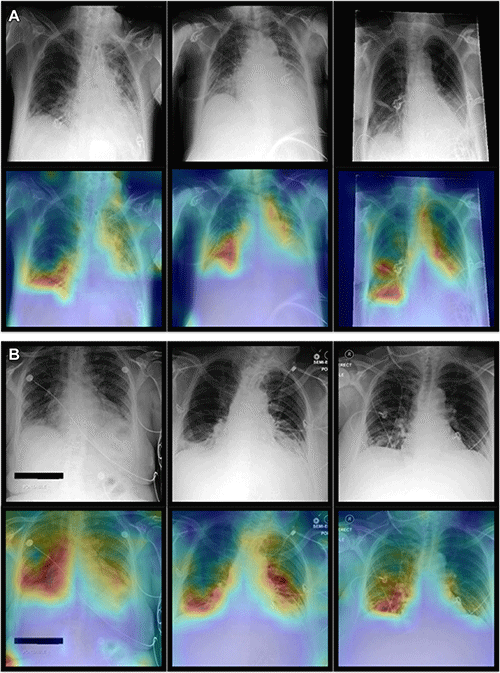 Neural Network Model to Improve Diagnostics Performance on Chest X-Rays