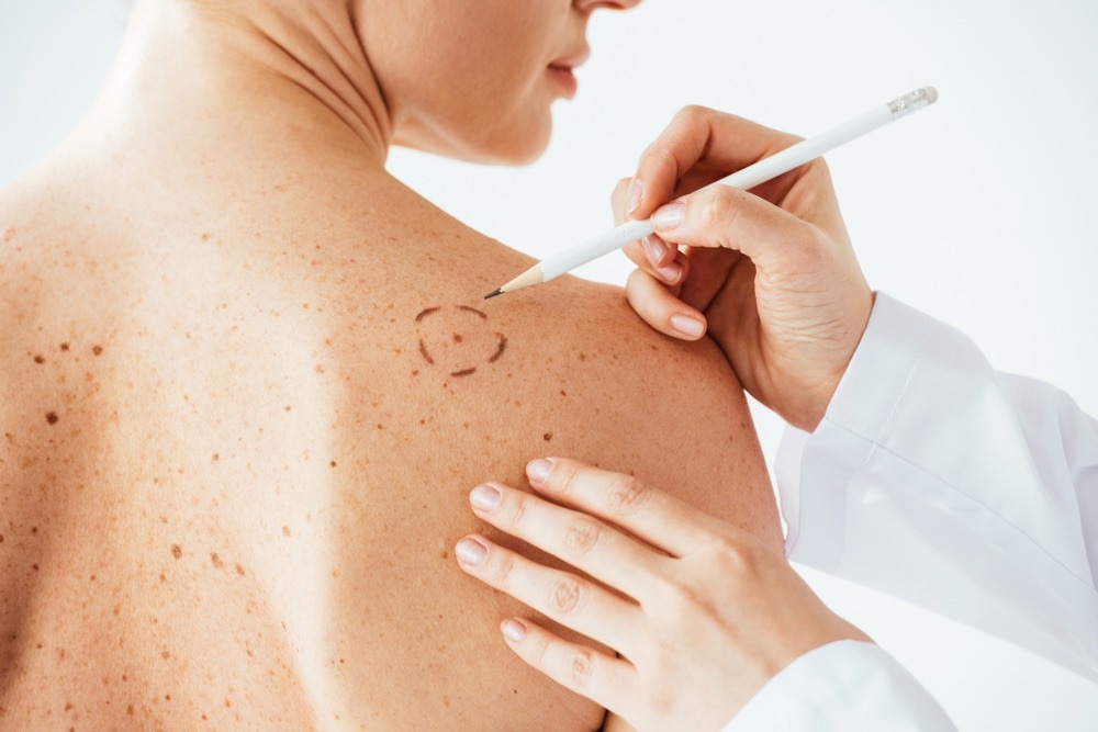 AI Software Achieves 100% Melanoma Detection Rate