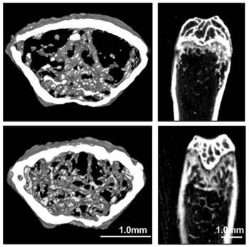 AI Algorithm Finds Dihydroartemisinin as Potential Osteoporosis Treatment