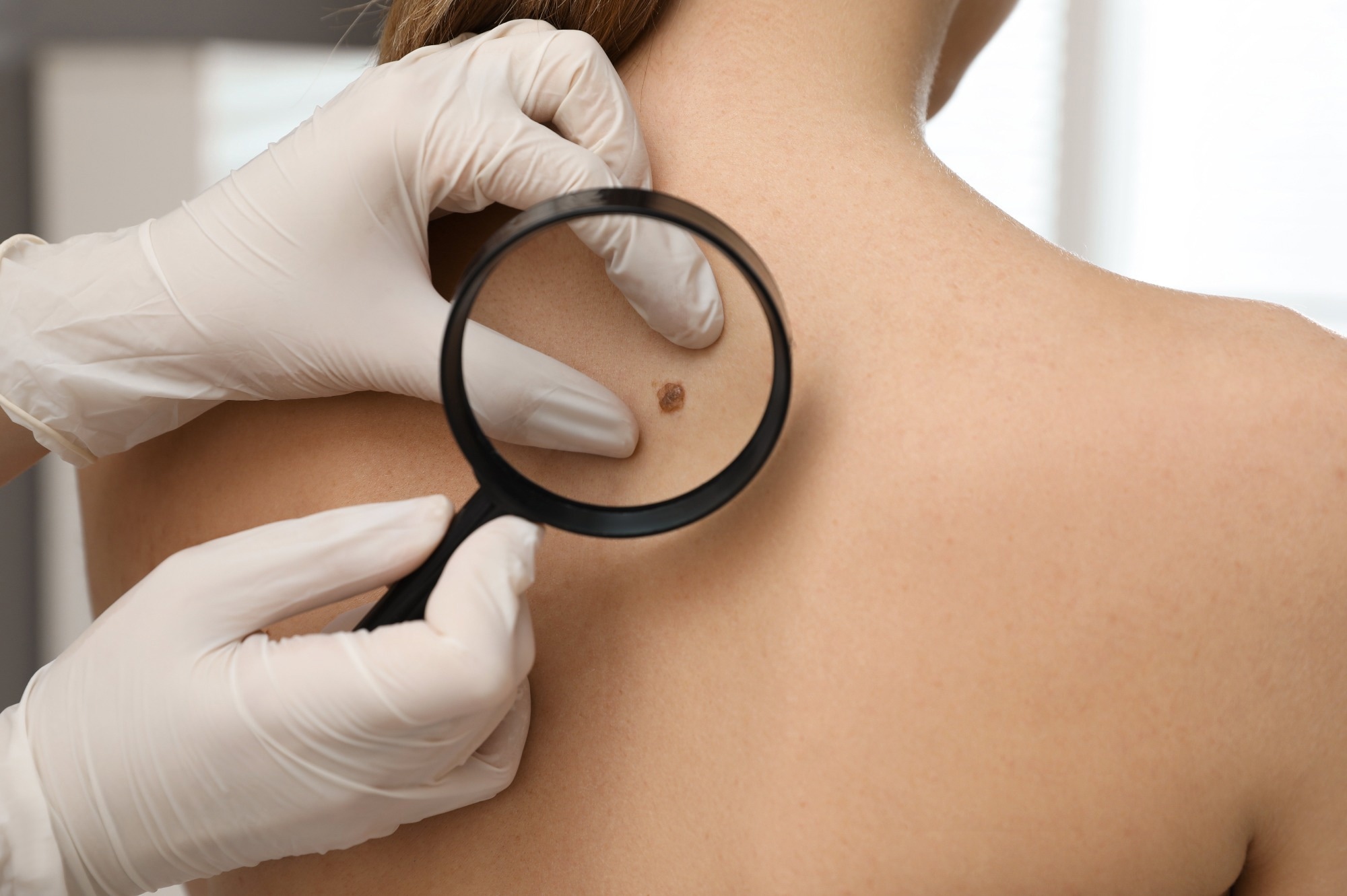 New AI-Powered App Could Improve Early Detection of Skin Cancer