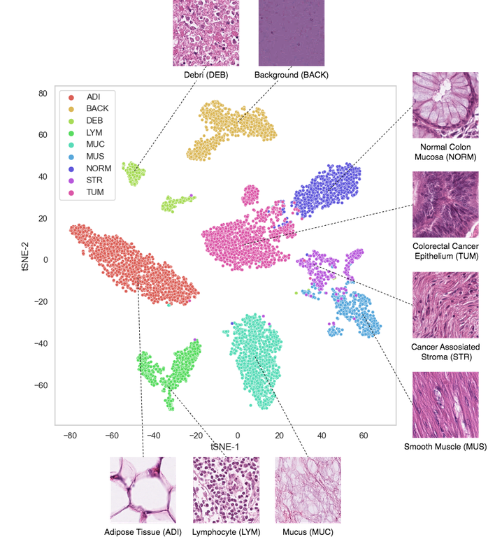 New AI Solution for Colorectal Cancer
