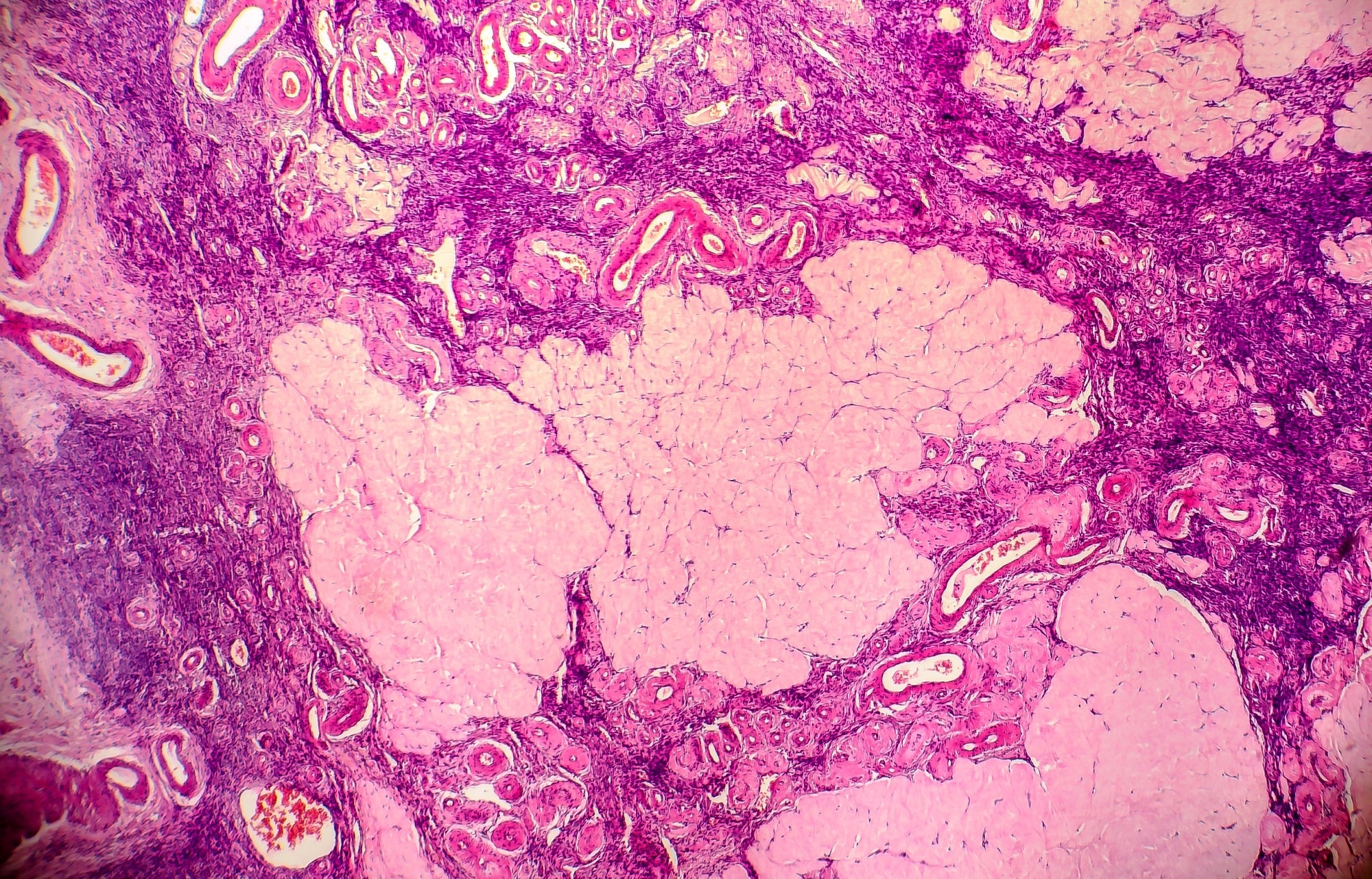 AI Algorithm Sets New Standard in Sarcoma Diagnosis and Treatment