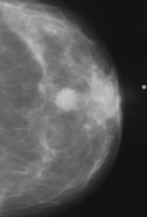 AI-Powered Risk Assessment Mitigates Racial Bias in Breast Cancer Diagnosis