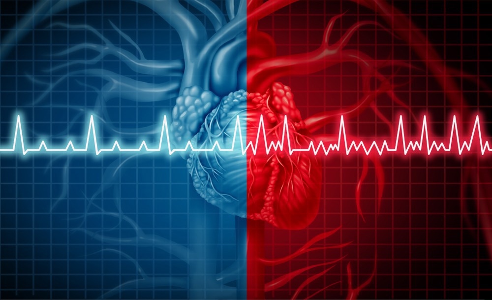 New AI Model Could Revolutionize Atrial Fibrillation Screening