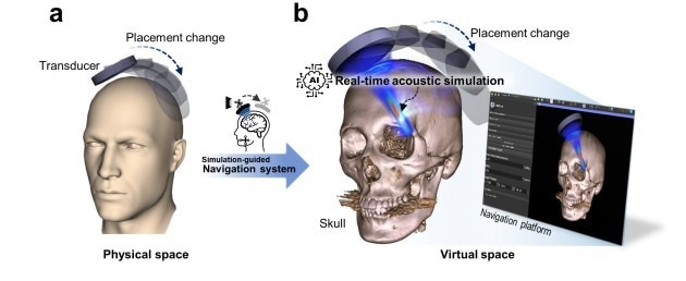 AI Reduces the Obstacles to Treating Ultrasonic Brain Disease
