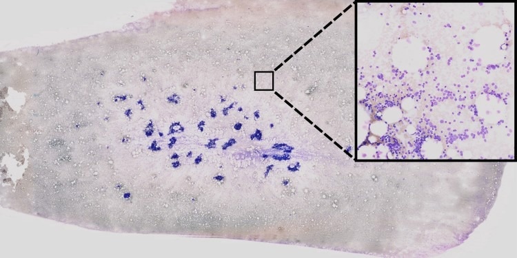 New Method for Recognizing Genetic Aberrations