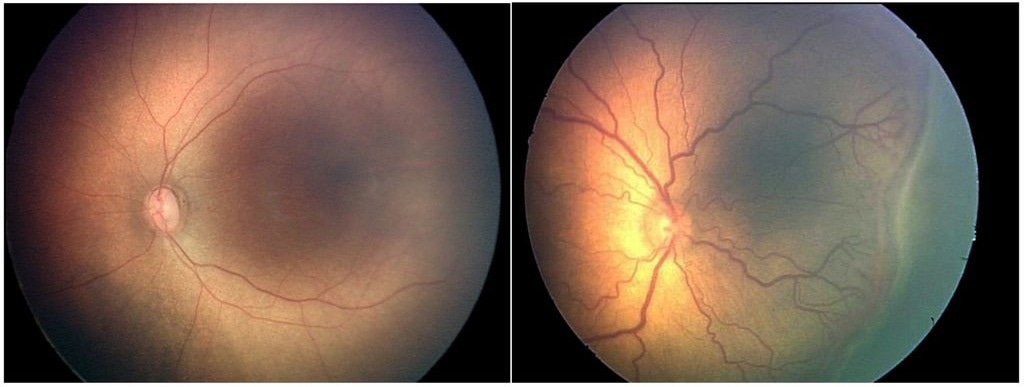 AI Helps Detect Blindness-Causing Condition Affecting Preemies