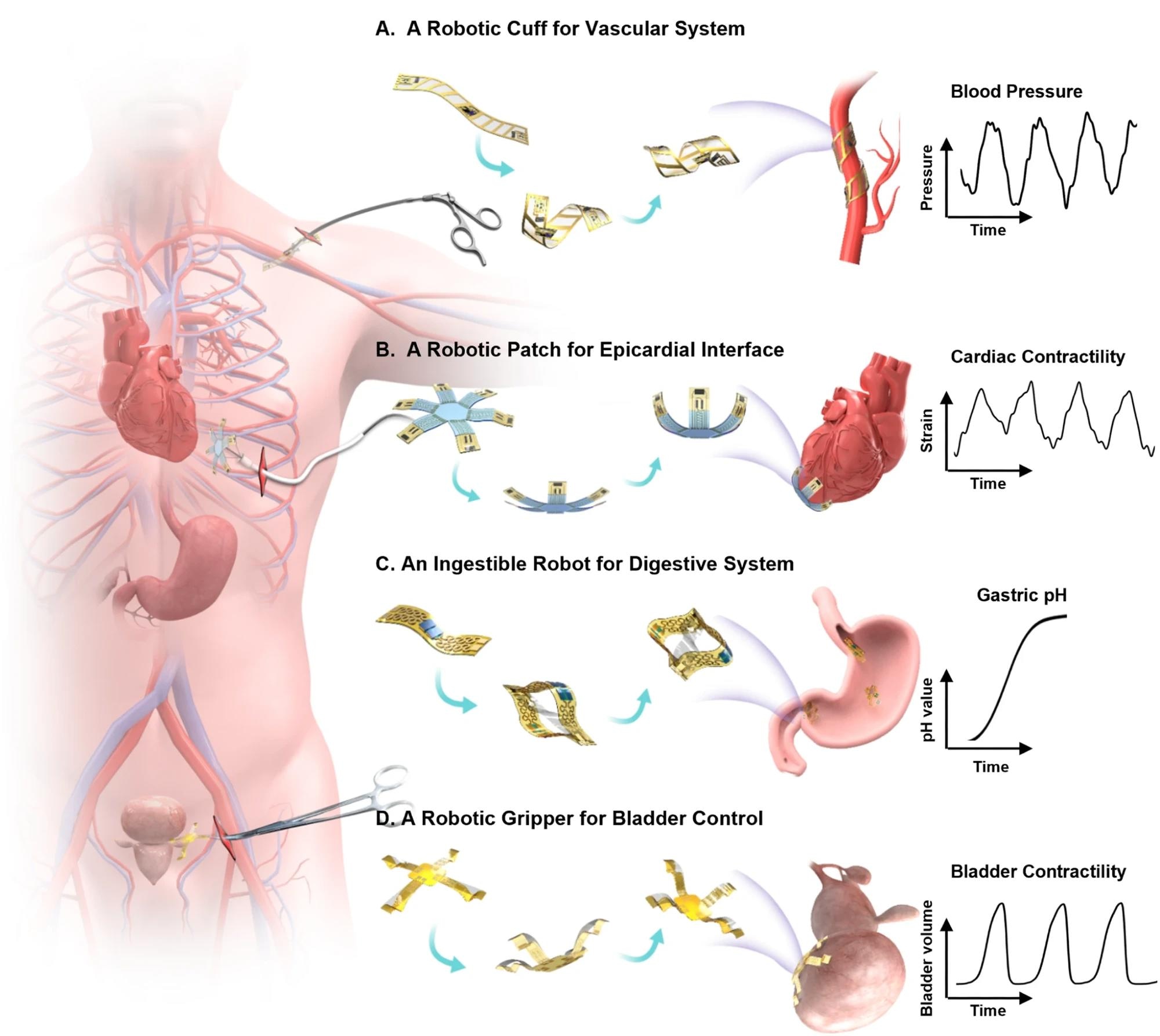 Revolutionizing Medical Implants with Soft Robotics