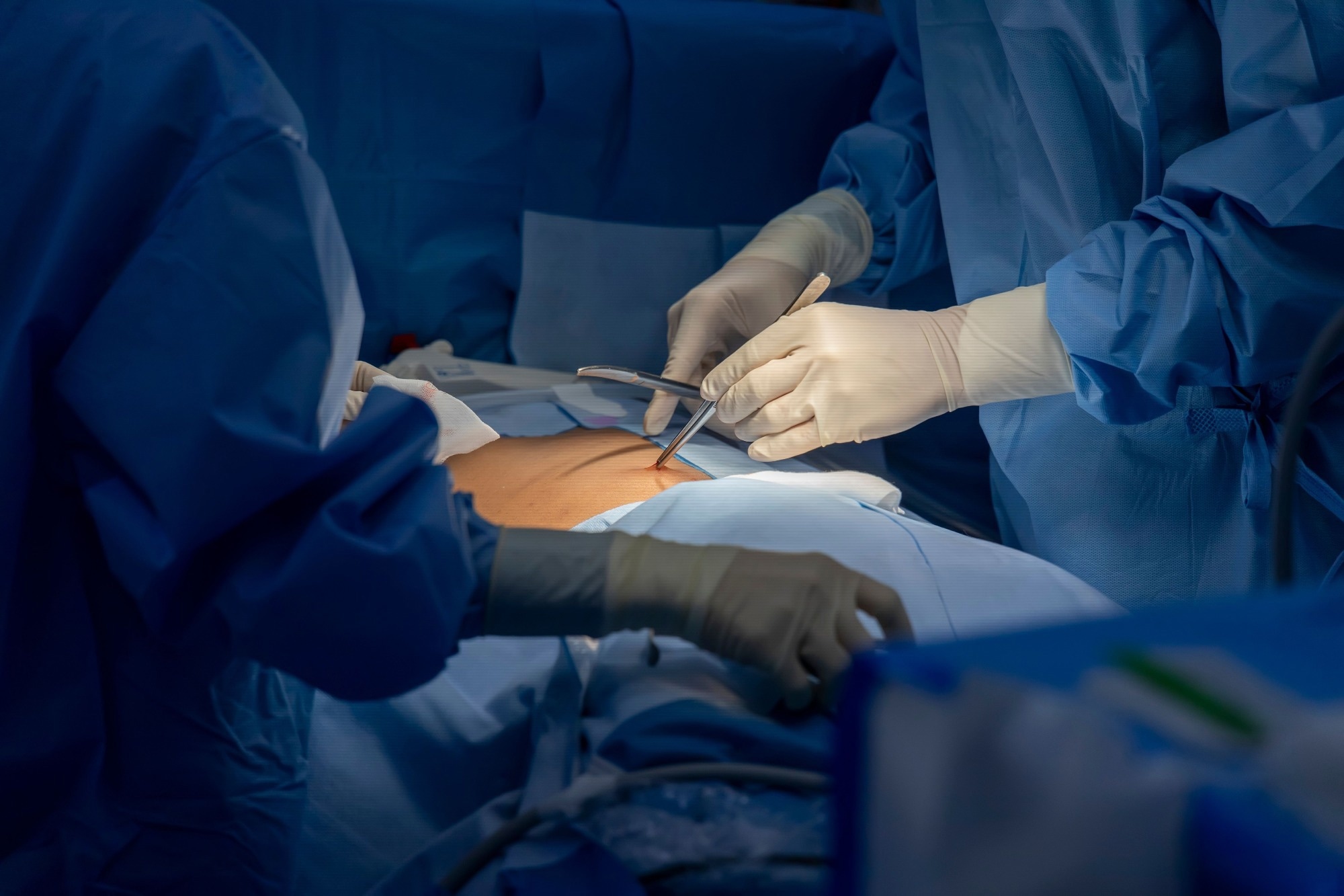 Conventional vs Robotic Laparoscopy for Endometriosis