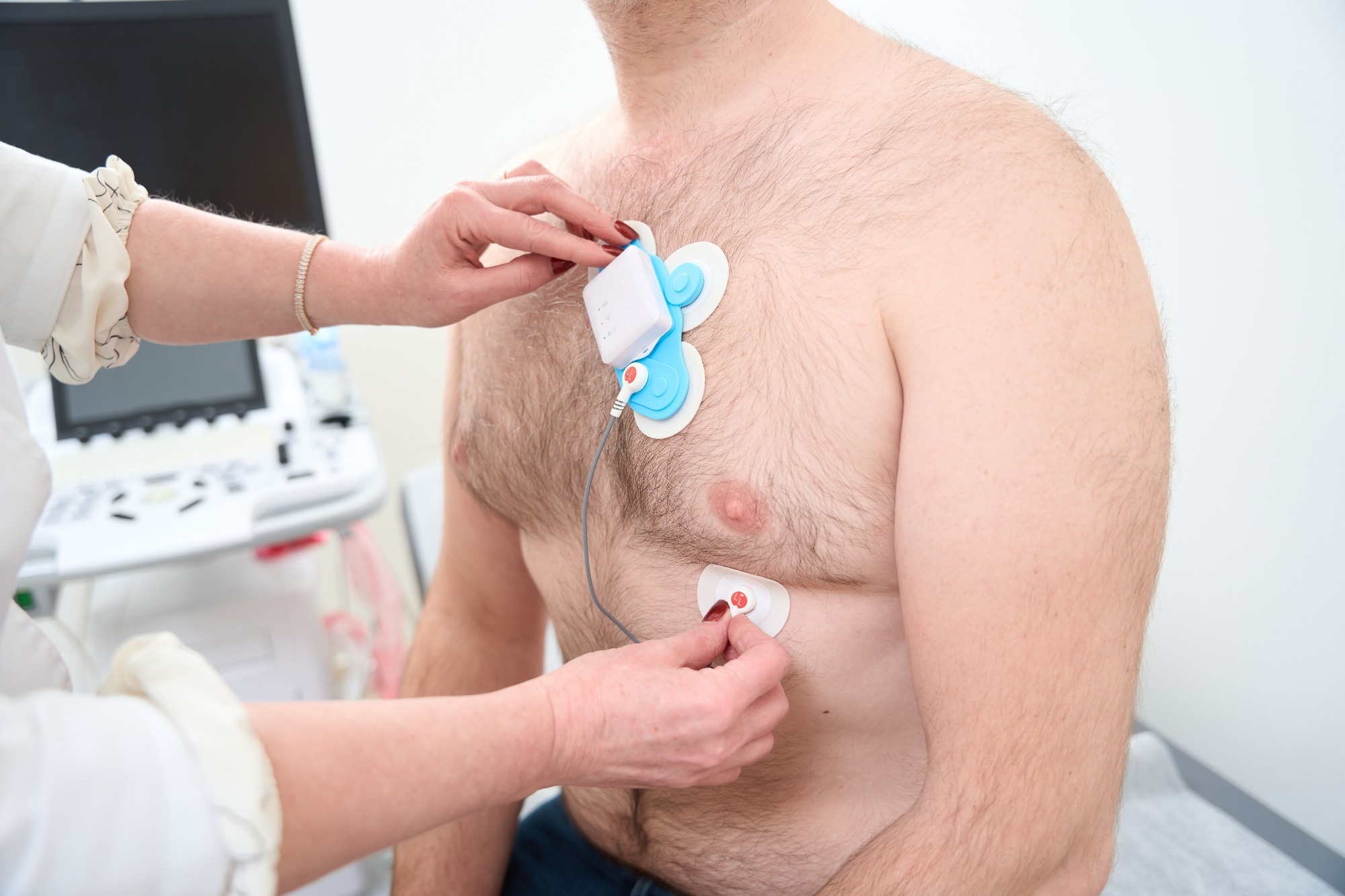 SmartSleeve: A Soft Robotic Device for Epicardial Drug Delivery