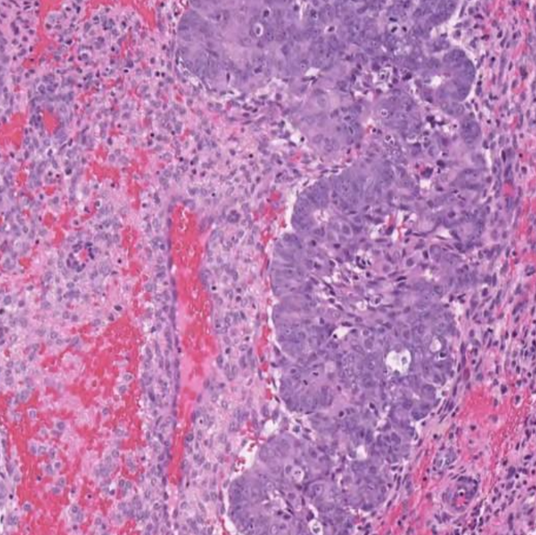 AI Unveils New Layer of Risk in Endometrial Cancer