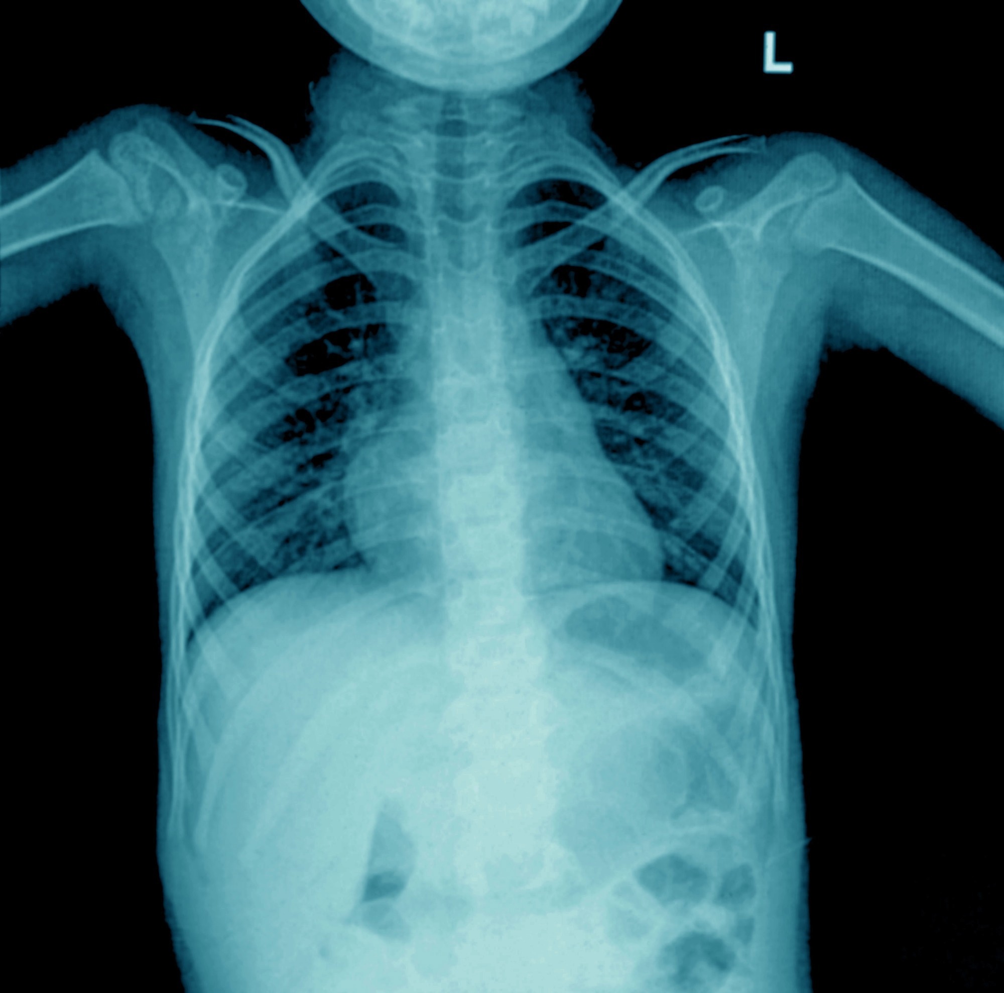 Pneumonia Detection Using Deep Learning
